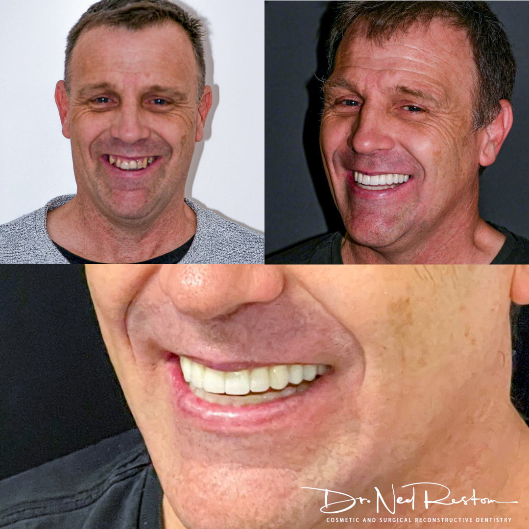 Dr Ned Restom's Patient – Before and After | Dental Implants On the Central Coast